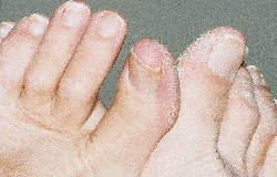 Red streak on left toe, none on right