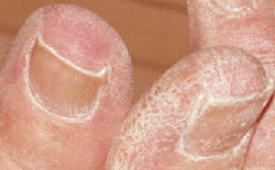 As layers of skin peeled off my toe became shiny.