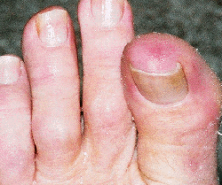 But just a few days earlier a tiny white dot in the reddest bit would not scrape off. It appeared to be the top of something embedded in my toe. Could it be the poison drawn out by the Epsom salt?